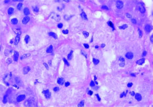 Red staining acid fast bacteria (AFB, 1000x)
