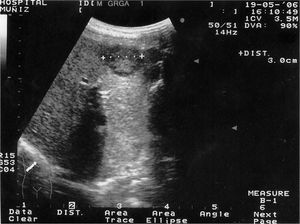 Abdominal sonography showing a large lesion occupying the left liver lobe.