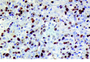 MUM-1 expression in the neoplastic cells.