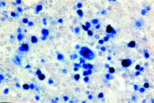 ISH (EBERs of EBV), positive in the atypical cell.