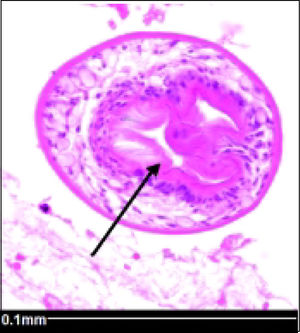 Echinococcus granulosus cyst with internal protoscolex (arrow).