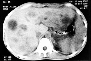 Abdominal CT showing multiple hypodense nodules in the liver.