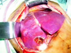 Intra-operative aspect of the liver with multiple pyogenic abscesses caused by Streptococcus constellatus.
