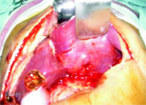 Intra-operative aspect of the ruptured pyogenic liver abscess on the left lateral hepatic segment (III).