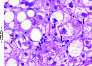 Cellular ballooning with Mallory-Denk bodies (arrows) in a subject with non-cirrhotic NASH. (H&E, 400x).