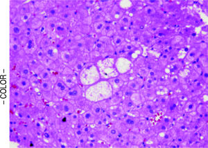 Ballooned hepatocytes (center) within a cirrhotic nodule in a subject with non-specific cirrhosis but with antecedent biopsy showing non-cirrhotic NASH. (H&E, 200x).
