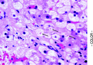 Megamitochondria (arrows) within a cirrhotic nodule in a subject with non-specific cirrhosis and with prior biopsy showing non-cirrhotic NASH. (H&E, 400x).