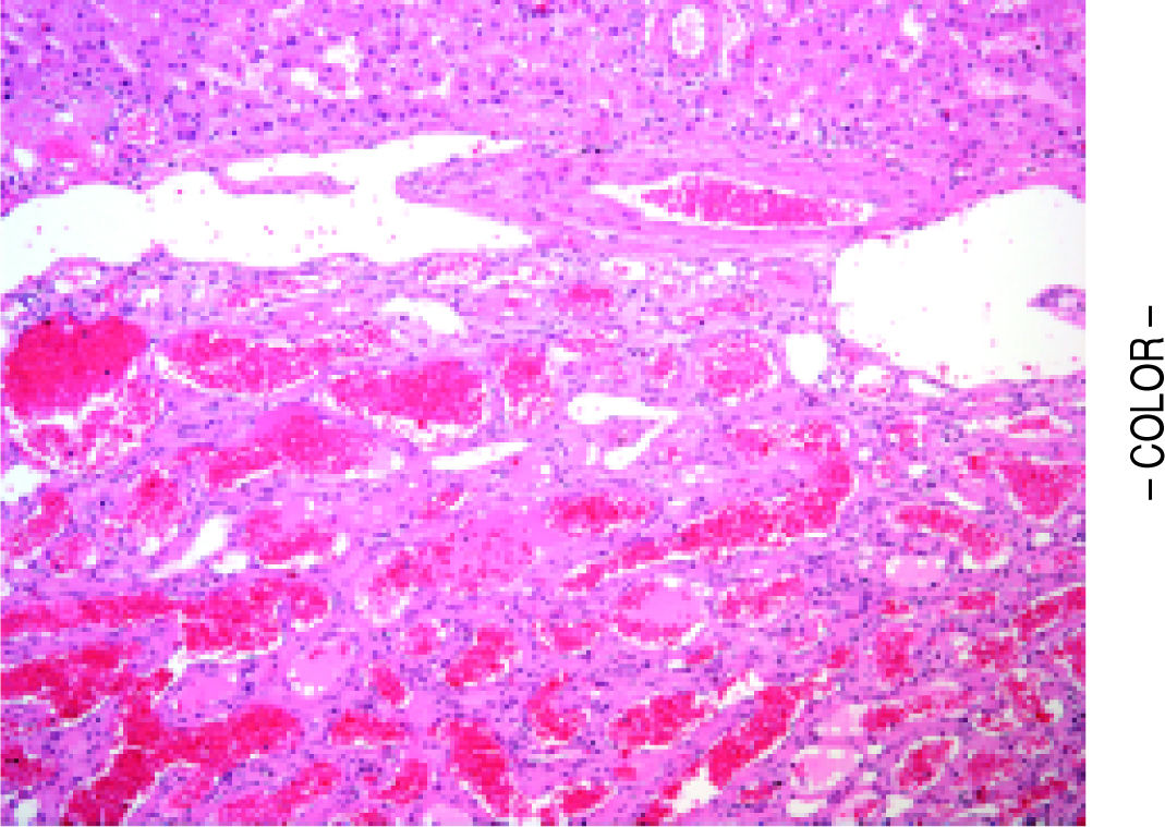 A giant hepatic hemangioma treated successfully with hepatic
