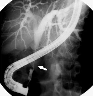 ERCP image demonstrating biliary dilatation. ERCP demonstrating marked intra-and extra-hepatic biliary dilatation to the level of the ductal anastomosis, with a sharp transition in ductal caliber from the donor to the native duct and a long segment of narrowed native common bile duct near the pancreatic head.