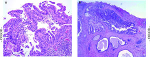 Common bile duct biopsy. Common bile duct biopsy reveals micropapillary proliferation of the biliary epithelium with some small budding cluster into the lumen. Abnormal large nuclei with hyperchromasia and loss of nuclear polarity are present. Multiple biopsies of the stricture and native common bile duct showed biliary intraepithelial neoplasia 3 with suspicious area of invasive adenocarcinoma.