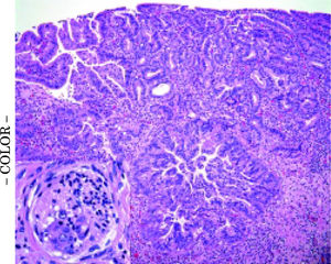 Distal common bile duct biopsy. Distal common bile duct biopsy from Whipple procedure shows high-grade biliary dysplasia with invasive adenocarcinoma and perineural invasion (inset).