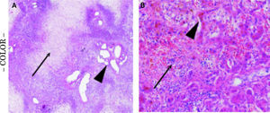 Microscopic specimen in low (A). 50x and high (B). 200x, magnitude amplification obtained by laparascopic liver puncture. Biopsy specimen revealed vanishing hepatocytes in the central parenchyma (Panel A, arrow) and portal fields with ecstatic lymph vessels (Panel A, arrowhead) compatible with severe perfusion disturbances. Higher magnification displayed bile duct proliferation (Panel B, arrow) and atrophic hepatocytes (Panel B, arrowhead). There is no relevant inflammation and no indication for liver vein thrombosis.
