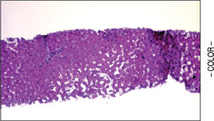 Nodular regenerative hyperplasia. The trichrome stain shows a centrovenular sinusoidal dilatation and an absence of increased fibrosis (S × magnification).