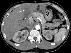 Contrast enhanced CT through the upper abdomen in the arterial phase following contrast injection showing occlusion of the celiac axis immediately distal to its origin (thick arrow), and occlusion of the hepatic artery. Area of low density in the left lobe of the liver compatible with area of infarction (white arrow). A surgical clip is present at the hepatic hilum (thin arrow).