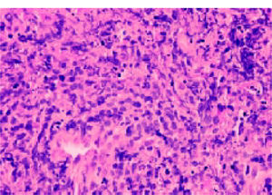 18-gauge French liver core biopsy at x400 magnification showing a diffuse infiltrate of predominantly large neoplastic lymphoid cells, with strong membrane staining for CD20 indicative of diffuse large B cell lymphoma and, in this context, consistent with monomorphic Post Transplant Lym-phoproliferative Disorder (PTLD).