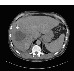 Cross sectional CT scan showing a 5.7cm hypodense lesion within the right lobe of the liver.
