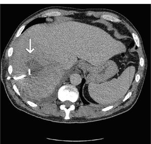 Cross sectional CT scan showing a reduction in size of the abscess following radiological drain placement.