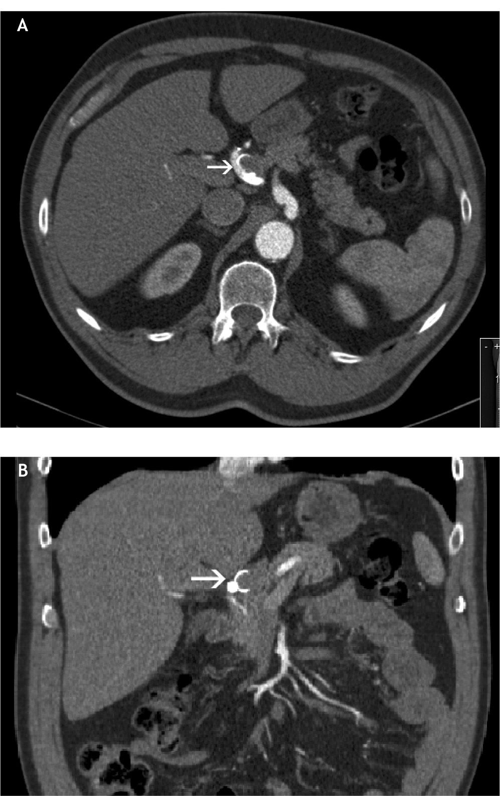 Endovascular treatment of a hepatic artery aneurysm causing chronic ...