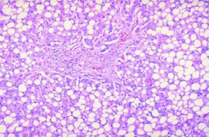 Liver-steαtosis induced by chemotherapy, H&E staining.