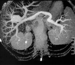 Three-dimensional CT angiographic reformations demonstrate saccular dilation at the connection region of the main and the left portal veins, without arteriovenous fistula or portosystemic communication.