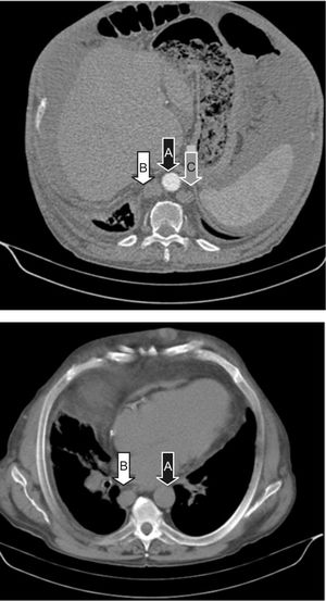 Congenital absence of the inferior vena cava. A. Black arrow-aorta. B. White arrow-azygos vein. C. Grey arrow-hemiazygos vein.