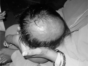 Cicatricial alopecia in NISCH syndrome.
