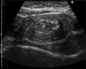 Sonographical picture of an intussusception.