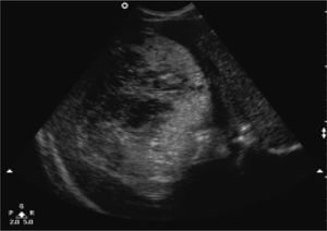 Transverse ultrasound scan of upper abdomen showing a large, complex cystic lesion in the right lobe of the liver with multiple internal septations and low level internal echoes.