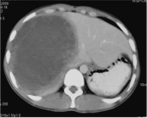 Contrast enhanced CT axial section of abdomen revealing well defined hypodense mass in the right lobe of liver with few enhancing internal septations.