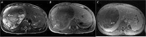 Axial T2 weighted (A) MRI showing heterogeneously hyperintense mass in the right lobe with hypointense internal septations (arrow). Axial T1 weighted (B) image shows areas of haemorrhages within the mass (arrow). Post gadolinium (C) images showing enhancing septations (arrow).