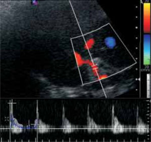 Color Doppler ultrasound 24 hrs after the OLT, showing a hepatic artery with flow velocity of 36 cm/sec and a resistance index of 0.84.
