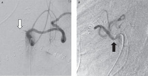 A. Digital substruction angiography in anteroposterior projection of the celiac artery showing lack of opacification of the hepatic artery (white arrow). B. Lateral projection during end expiration showing an indentation at its origin (black arrow).