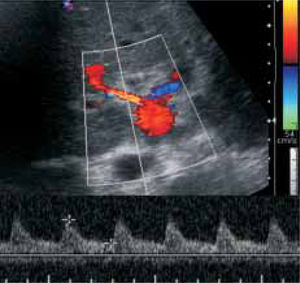 Color Doppler ultrasound after surgical median arcuate ligament division, showing a hepatic artery with a flow velocity of 120.5 cm/sec and resistance index of 0.66.