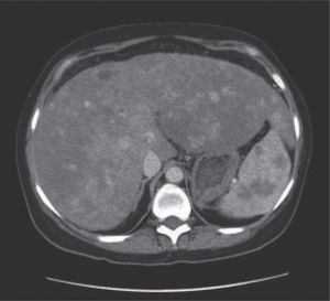 Contrast-enhanced CT scan of the abdomen after 91 months of treatment with thalidomide in a patient with hepatic epithelioid hemangioendothelioma. The tumor burden diminished after therapy compared with baseline CT. Characteristic’s findings show diffuse hepatosplenomegaly with multiple focal hipervascular, with a target pattern of enhancement in larger lesions in the liver and hipovascular lesions in the spleen.