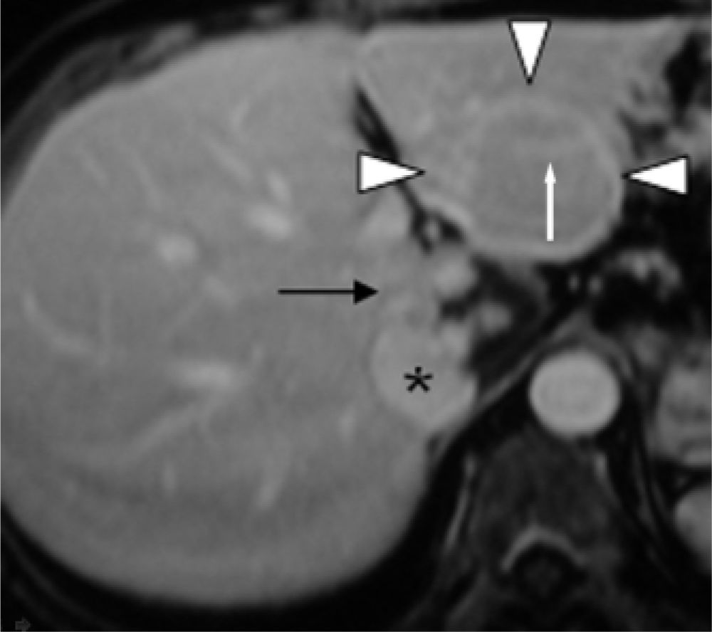 Fnh Shape Focal nodular hyperplasia vs. hemangioma: Computed tomography and ...