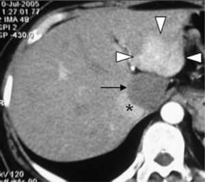 Contrast-enhanced CT image obtained during early arterial phase shows strong hyperdensity of FNH lesion (arrowheads) to normal liver in segment 2. Hemangioma (black arrow) in segment 1 just adjacent to FNH shows no enhancement. Vena cava inferior (*).