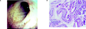 A. Endoscopic view of yellow discoloration in proximal duodenum. B. Fat-laden enterocytes located in the upper portion of the villus by light microscopy.