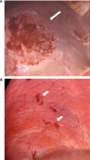 Laparoscopic view of the surface of the right lobe of the liver showing a 6 × 5 cm irregular rounded hemorrhagic area of endometriosis (A). Right upper parietal peritoneum view showing multiple small patches of endometriosis (B).