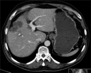 CT image in porto-venous phase showing the gallbladder carcinoma, growing from the gallbladder bed in cranial direction into the liver parenchyma (segment 4a).
