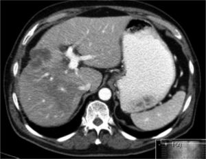 Six weeks follow-up CT image, showing stable disease according to the RECIST 1.1 criteria.