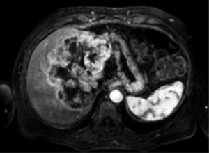 Contrast-enhanced MRI of the liver showing the intrahepatic cholangiocarcinoma (before treatment).