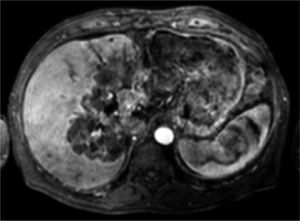 Contrast-enhanced MRI of the liver with the intrahepatic cholangiocarcinoma (three months after treatment), showing partial response according to the EASL criteria.