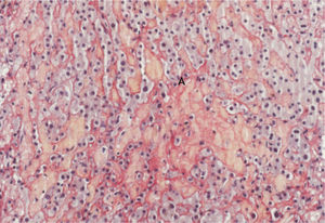 Liver biopsy showing a pattern of hepatic sinusoidal dilatation (HSD) with presence of a cystic blood filled space in liver parenchyma (A) (picrosirius stain, original magnification x 200). Round intralobular cavities filed with red blood cells and hemorrhagic suffusion.