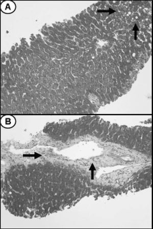 A. Microphotograph showing the presence of mild macrovesicular steatosis in the liver biopsy (arrows) (H&E × 250). B. Microphotograph showing an area of bridging fibrosis in the liver biopsy (arrows) (H&E × 250).