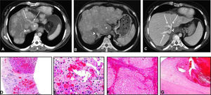 Axial contrast-enhanced CT images at the level of the confluence of the hepatic veins into the hepatic vena cava (>) and liver biopsy at the time of referral when Budd-Chiari syndrome was diagnosed. A. Demonstrates patent hepatic middle and left hepatic veins (arrows), and cirrhotic changes with regenerative nodules can be appreciated. B. A CT study three months after (A) shows complete obliteration of the hepatic veins with the absence of contrast enhancement. The liver is diffusely hypodense and hypertrophy of the caudate lobe (*) is present as a consequence of Budd-Chiari syndrome. C.A CT study 3 weeks following OLT shows regular parenchymal liver enhancement with patent hepatic veins. There is established cirrhosis [D, hematoxylin eosin (HE), ×100] as well as centrilobular congestion with sinusoidal dilatation, hemorrhage into the space of Dissé and centrolobular necrosis (E, HE, × 400). Examination of the explanted liver confirmed cirrhosis (F, elastin van Gieson, × 100) as well as organising thrombi in large hepatic veins: Budd-Chiari syndrome (G, HE, × 100).