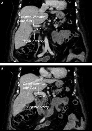 A and B. Abdominal computerized tomography (CT): compression of the extrahepatic bile duct by the right hepatic artery.