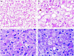 Alcoholic liver disease with typical alcoholic foamy degeneration changes. Case report # 1 (A and B). Mixed component of stea-tosis. Although ma-covesicular steatosis is present, large patches of hepatocytes with fat microvesicules filling and expanding the cytoplasm are present. Some bile canalicular thrombi can also be observed. Hematoxylin and eosin stain (H&E). Case report # 2 (C). Extensive areas of microvesicular steatosis could be seen. H&E. D. Areas of hepatocellular ballooning with focal presence of giant mitochondria were observed. H&E.