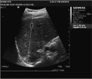 ARFI measurement in the liver.