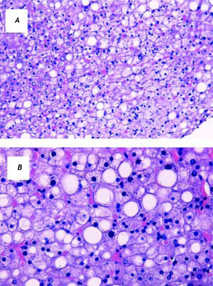 Liver biopsy, hematoxylin and eosin staining. Most of the hepatocytes appear to be enlarged and swollen, with pale cytoplasm and with polygonal shape. In addition, approximately 25% of hepatocytes show fat accumulation. No significant inflammation, fibrosis or cholestasis is present. Mallory hyaline bodies were not detected. A. Original magnification 20X. B. Original magnification 40X.
