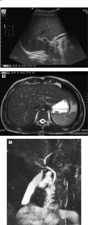 Imaging studies. A. Normal liver ultrasound. B-C. Magnetic resonance cholangiography shows extra and intrahepatic biliary system with normal appearance.